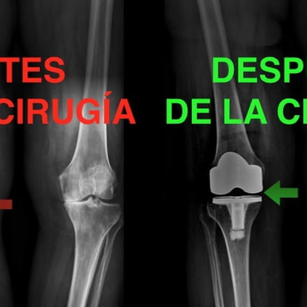 que-es-una-protesis-de-rodilla
