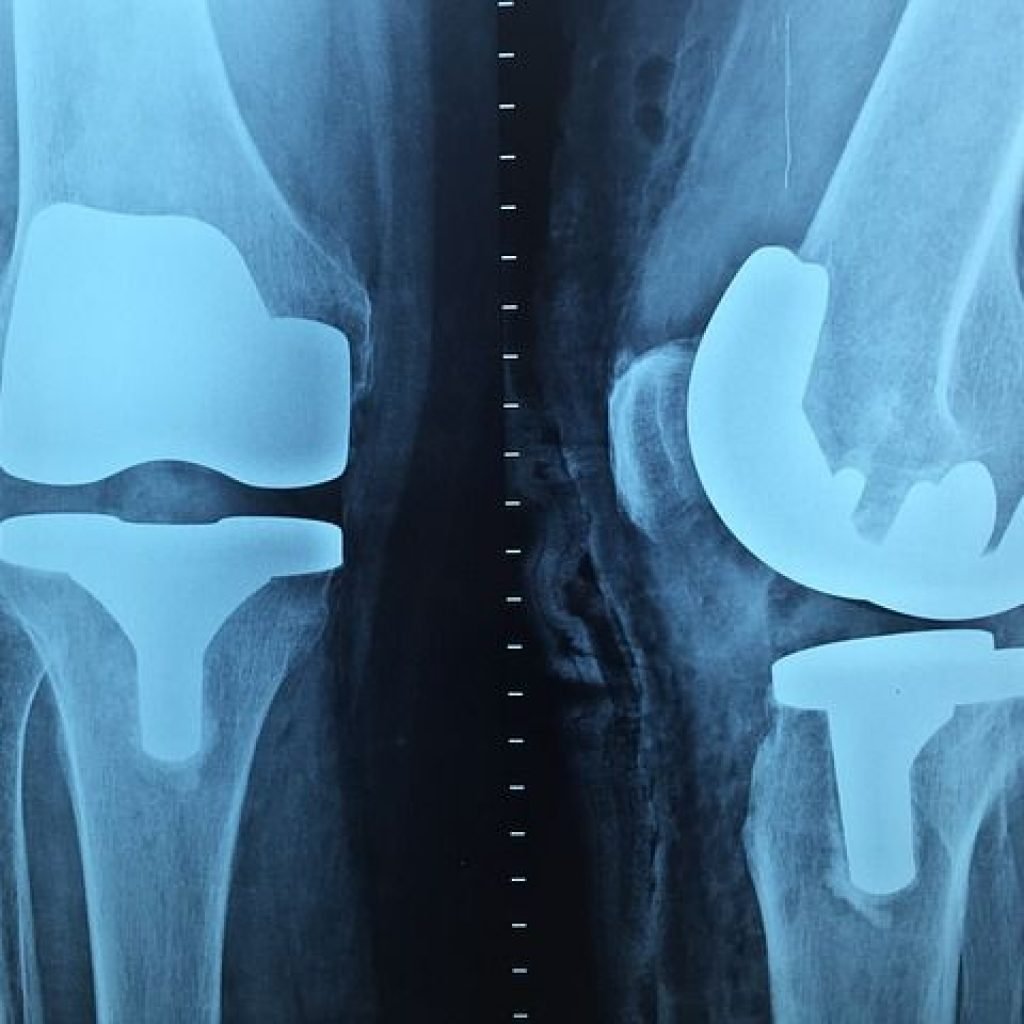 prótesis de rodilla precio en México