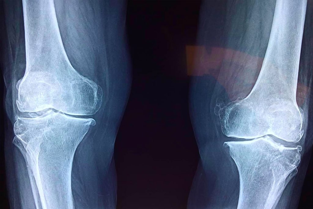 Tratamiento de osteoartritis