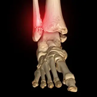 fractura solucionesortopedia