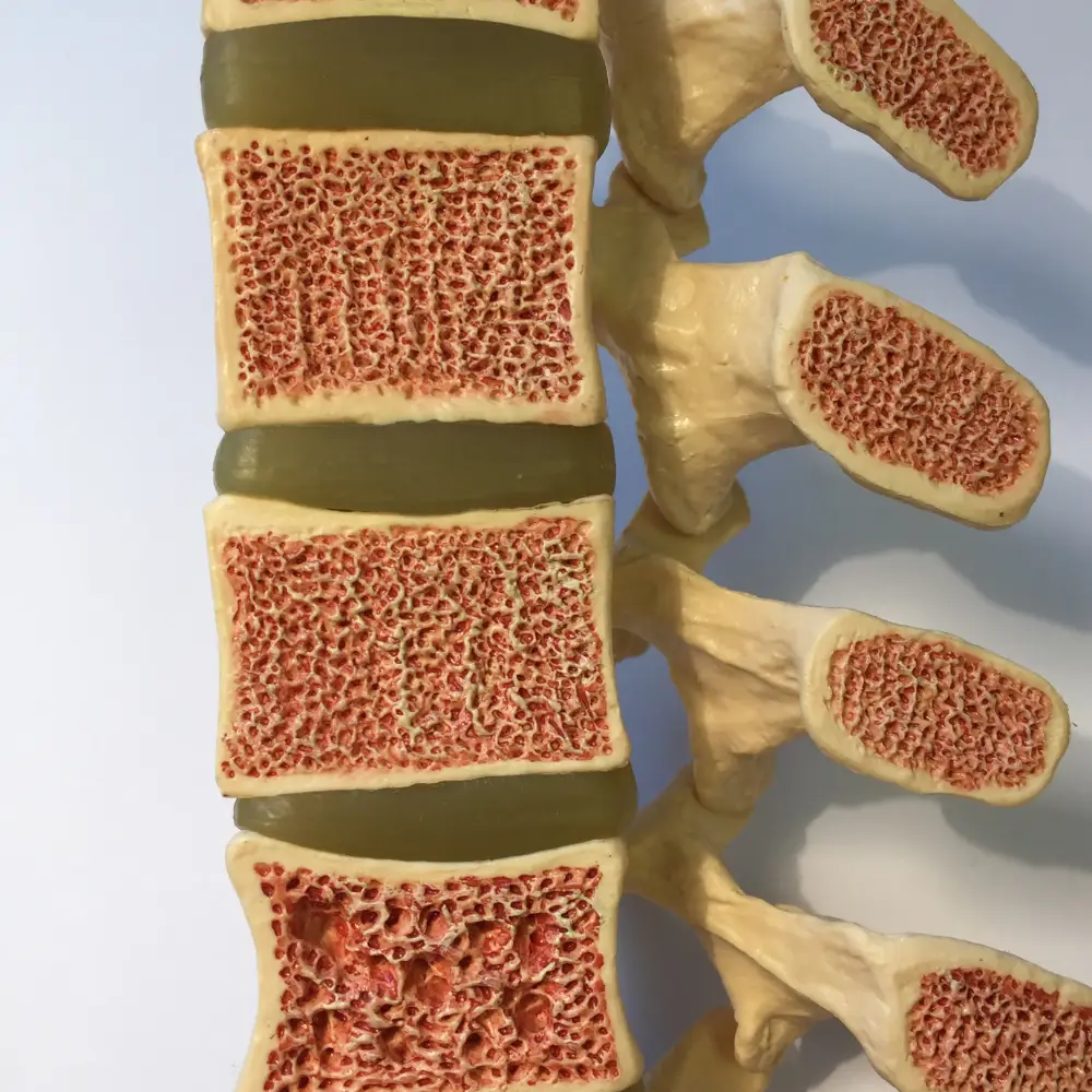 Osteoporosis