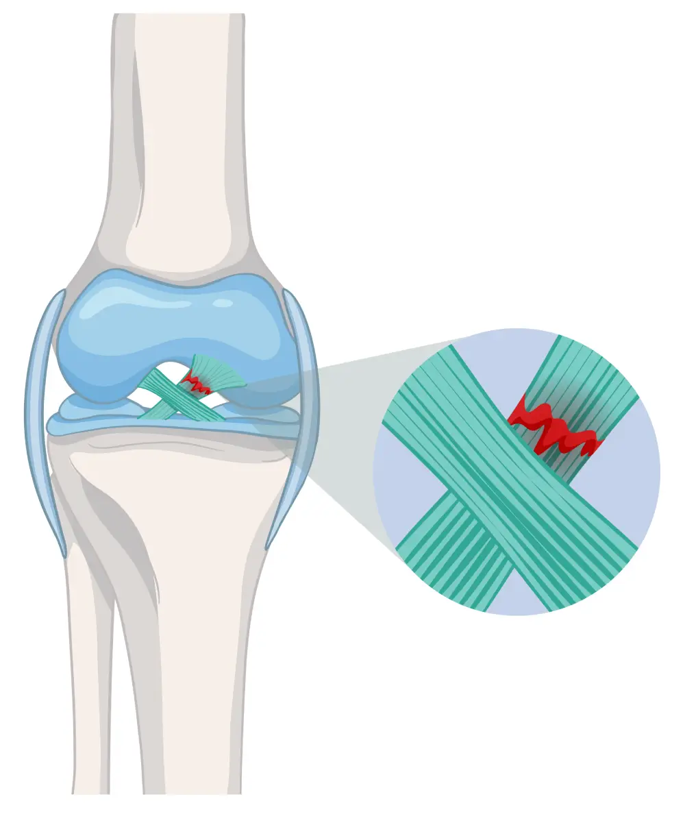 Reconstrucción de ligamentos