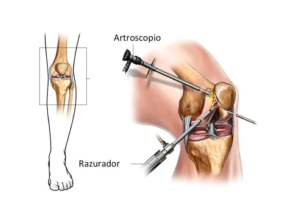Artroscopia de rodilla